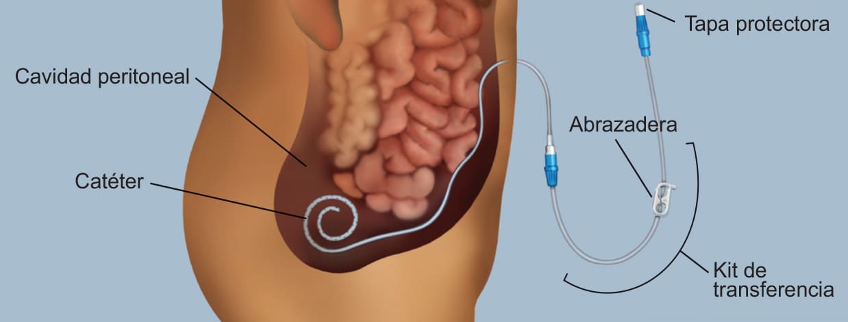 colocacion-de-cateter